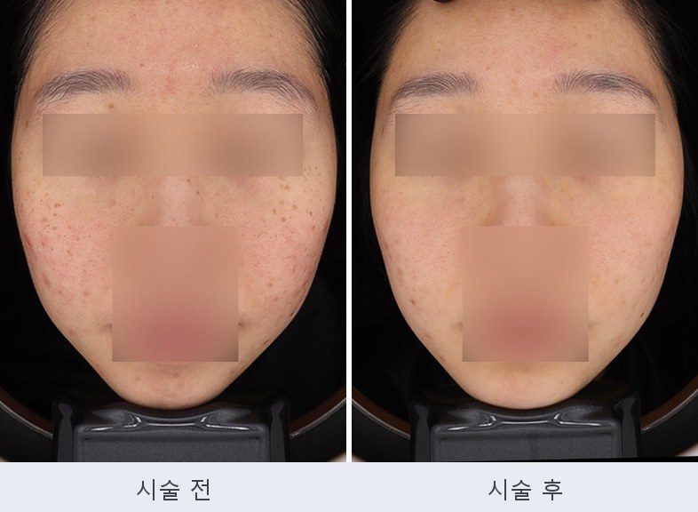 기미 주근깨 잡티